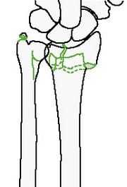 Классификация переломов длинных костей