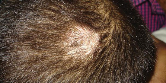 Грибок кожи головы: как распознать и лечить
